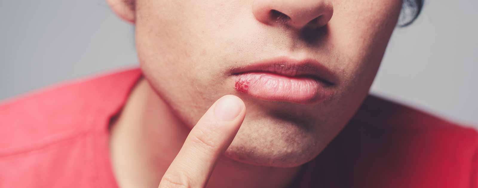 herpes-labial