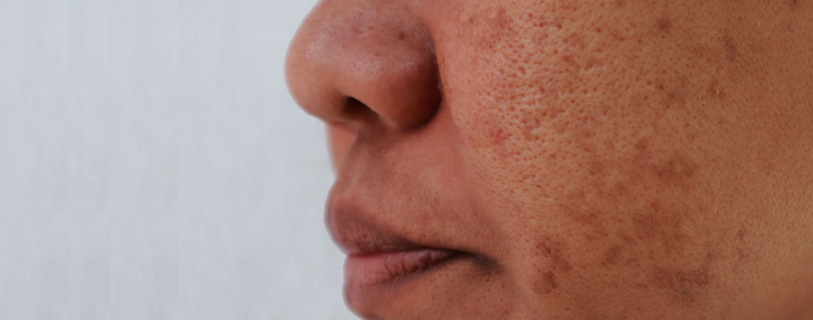 melasma