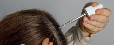 mulher a aplicar minoxidil no couro cabeludo