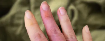 mulher com uma crise de síndrome de Raynaud