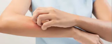 mulher a coçar o braço com vermelhidão 