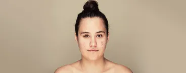 Cuidados acne