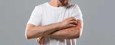 homem a coçar braço cheio de manchas vermelhas