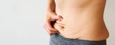 mulher com diastase abdominal 