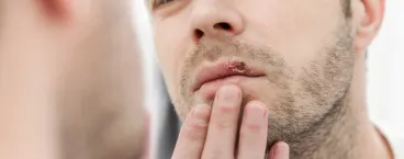 homem com herpes labial