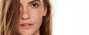 mulher jovem com manchas na cara 