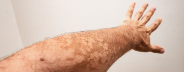 braço de homem com manchas de pitiríase versicolor