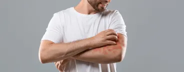 homem a coçar o braço com manchas