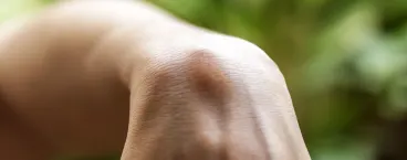 pessoa com quisto sebáceo na mão