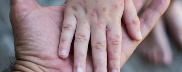 mão de criança com erupções