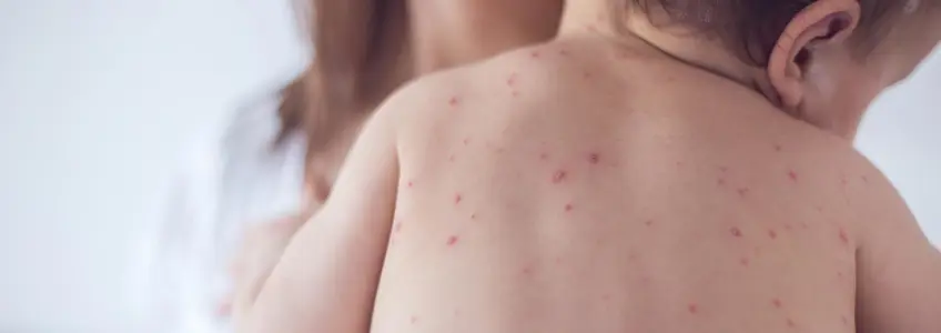 criança com marcas de varicela