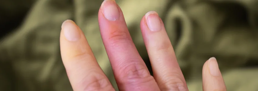 mulher com uma crise de síndrome de Raynaud