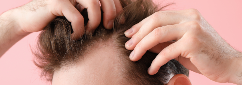 homem a verificar o seu cabelo para verificar se necessita de implantes