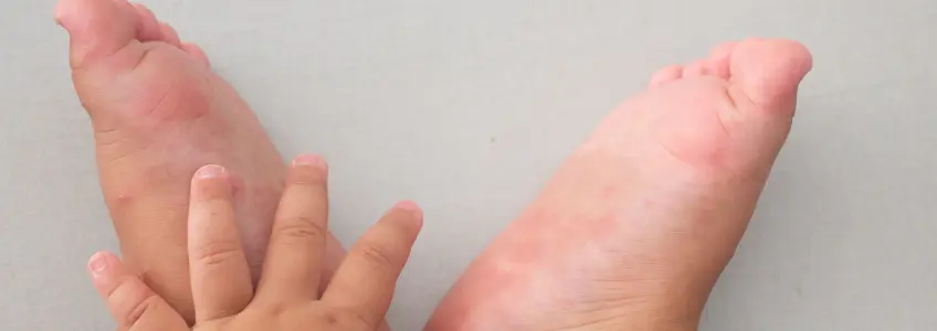 bebé com manchas vermelhas nos pés