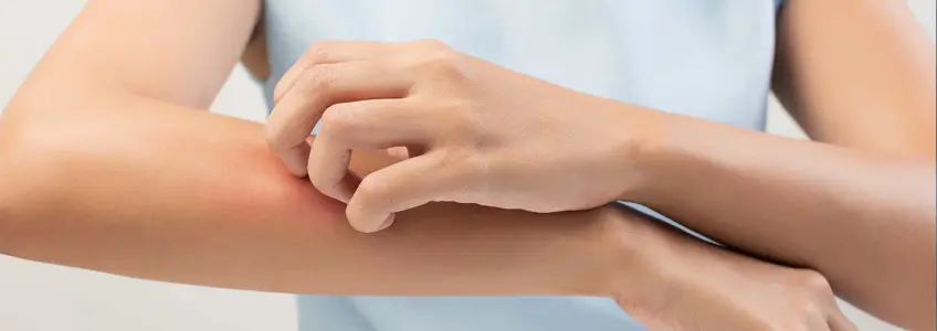 mulher a coçar o braço com vermelhidão