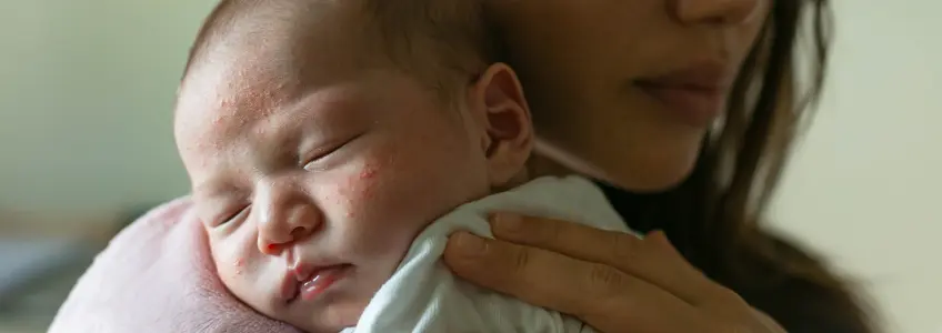mãe com bebé ao colo com placas amareladas no rosto