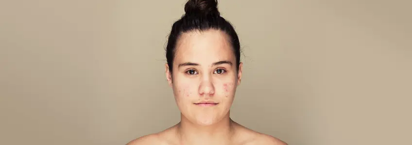 Cuidados acne
