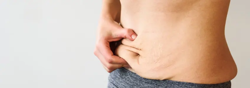 mulher com diastase abdominal 