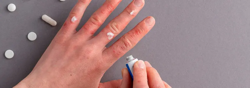 homem a colocar creme nas mãos para aliviar o eritema