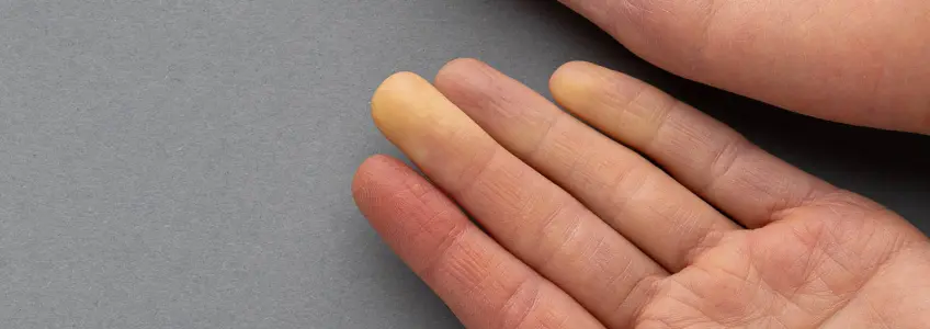 tratamento da esclerodermia