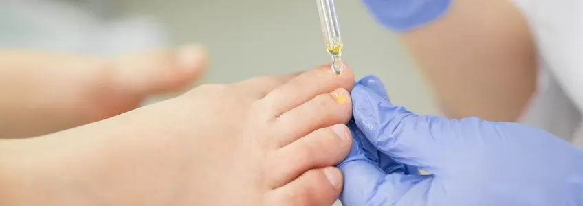 médico aplica antifúngico na unha de uma criança