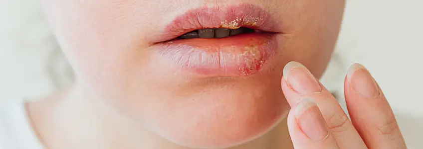 mulher com crostas no lábio causadas pelo herpes