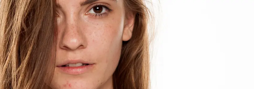 mulher jovem com manchas na cara