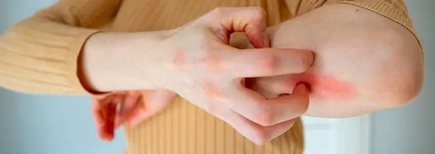 mulher com lesões no braço provocadas pela leishmaniose
