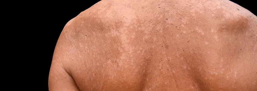homem com manchas de impigem nas costas