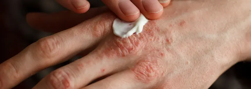homem a aplicar creme na mão