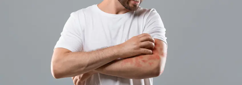 homem a coçar o braço com manchas