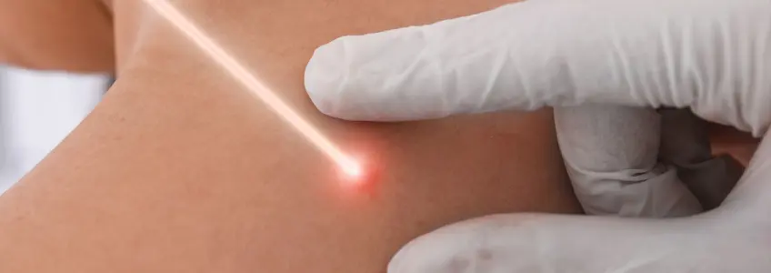 dermatologista usa laser para tirar sinal de paciente
