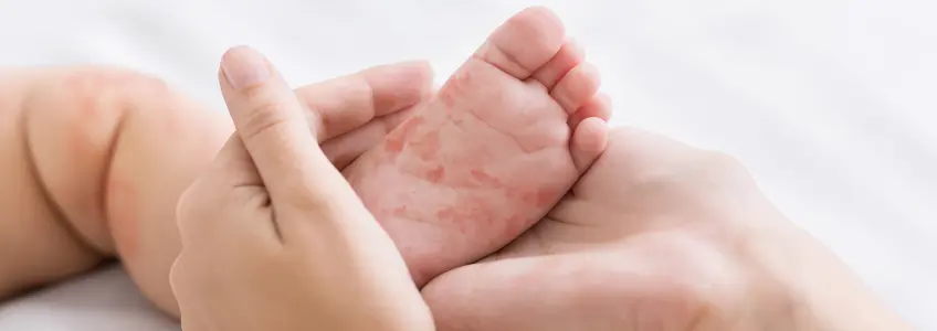 pé de bebé com erupções na mão da mãe