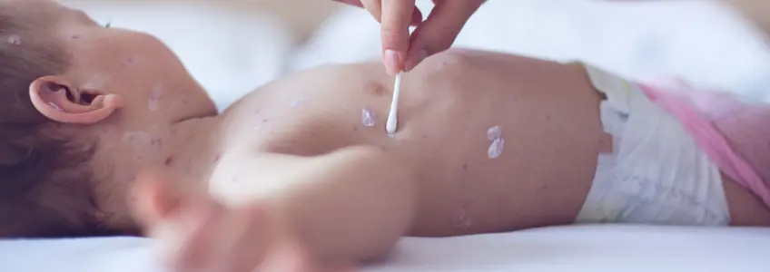 mãe a colocar pomada em manchas do bebé com cotonete