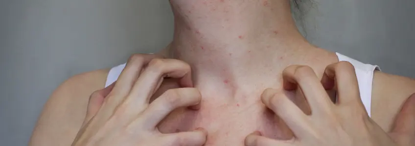 mulher com borbulhas no pescoço causadas pela sarna