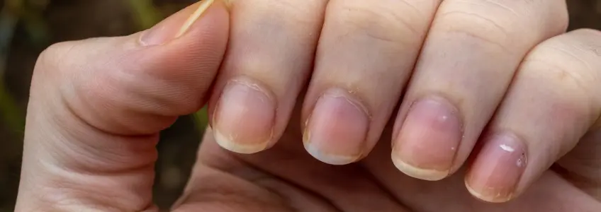 homem com as unhas amareladas
