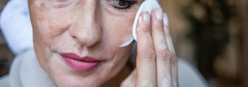 mulher com vitiligo a desmaquilhar-se